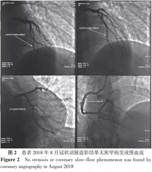 全科诊疗思路——冠状动脉无阻塞病变的变异型心绞痛患者的诊治过程