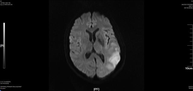 脑梗死|男子突发疾病疑似“脑梗”，区中心医院成功“揪”出背后“伪装元凶”