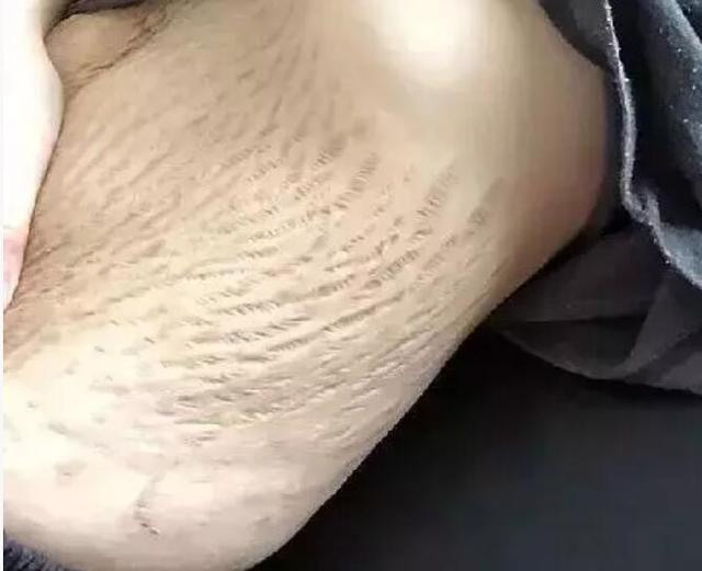 超级宝妈@双胞胎妈妈晒生娃前后肚子对比照：生孩子，比我们想的更“伤身”
