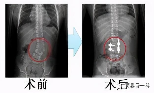 什么是脊柱侧弯？先天性脊柱侧弯与特发性脊柱侧弯的区别是什么？