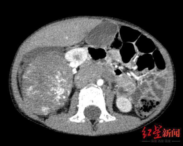 肿瘤|5岁男童肚中“暗藏”巨大神经母细胞瘤 医护6小时联手取出