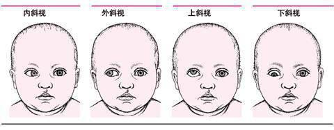 有趣生活|家长注意：这种视力问题，很容易忽视