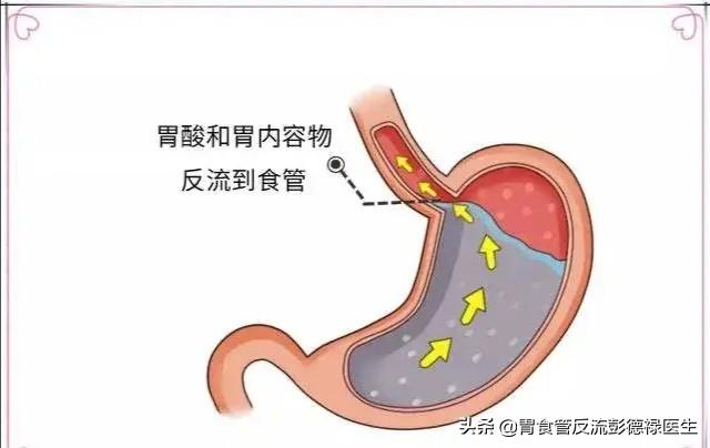 ?【胃食管反流都需要手术治疗吗？符合什么条件才需要手术？】