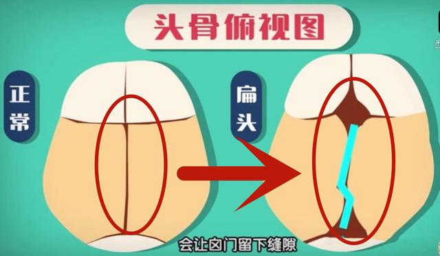 【天使宝贝】为何老一辈坚持给宝宝“睡扁头”，很影响宝宝的颜值，不信你看