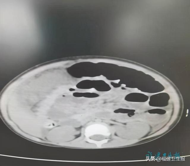 休克|宁德2岁女童呕吐两天后，肠子被部分切除！医生：呕吐严重可致命