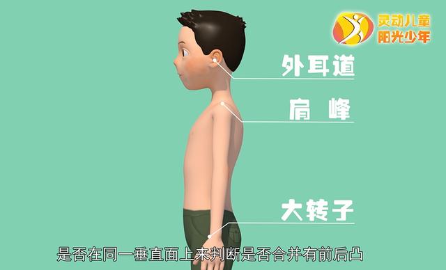 健康学堂|孩子高低肩，可能是病，这些脊柱侧凸自查方法，家长们一定要收藏