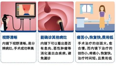 内痔|内镜下治疗痔疮，不做有“痔“一族