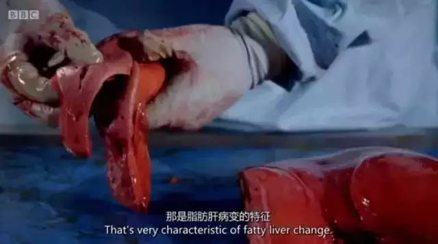 体重|一半国人超重！看完胖子的解剖内脏，只想减肥！