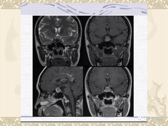 垂体病变的MRI诊断