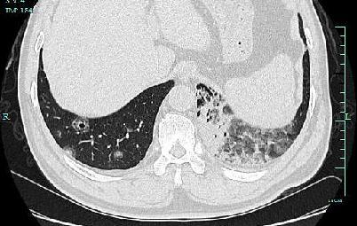 肺部|大伯肺里刮“台风”？竟然已是癌症晚期