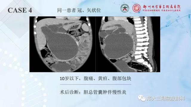 儿童腹部囊性病变诊断思路分析