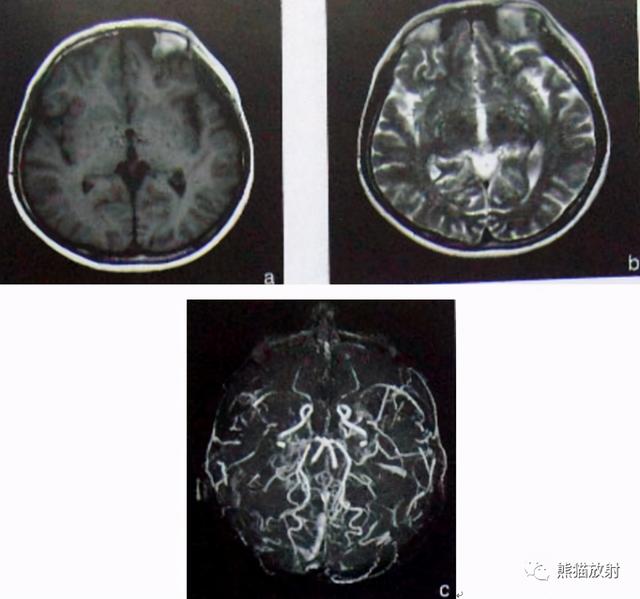 烟雾病的CT及MRI诊断