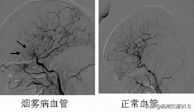 34岁杭州男子居然中风了，脑血管如同“烟雾”！妻子慌了神：平时他身体很好的