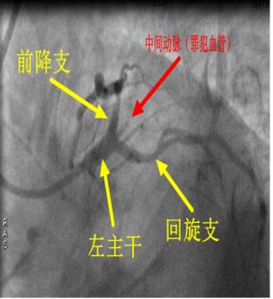 PCI术后胸痛之谜