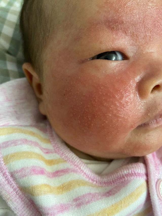 你的育儿经|因为婆婆的旧思想，导致宝宝严重湿疹，这些误区你中了几条？