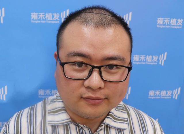 非那雄胺的真实有效率是多少（五位发友改善一年，终于告别稀疏）