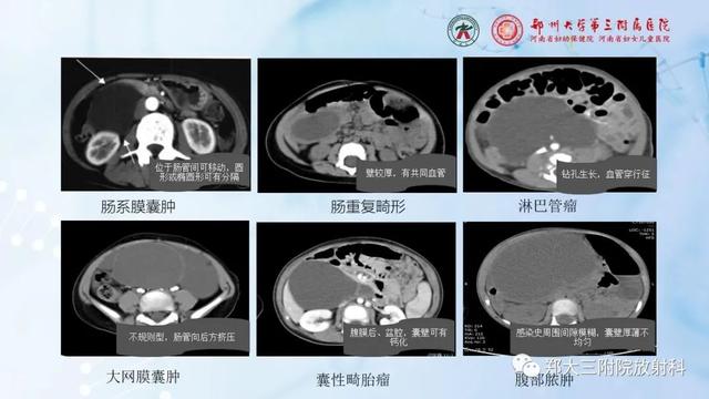 儿童腹部囊性病变诊断思路分析