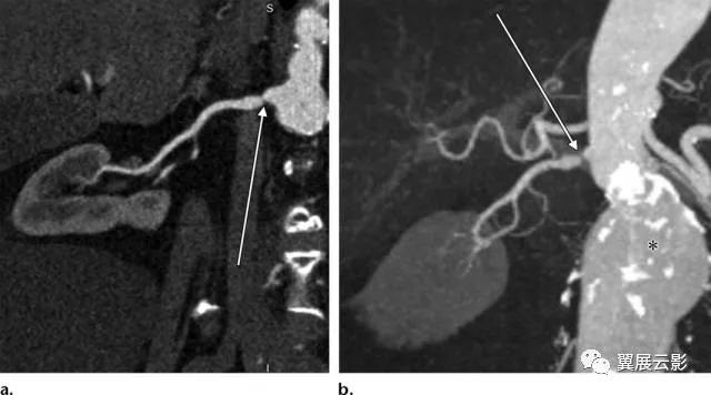 24张图汇总「肾血管」常见病变的影像学表现