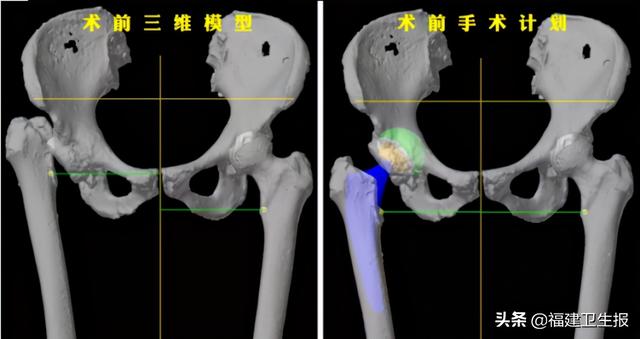 手术|全省首例！机器人辅助下完成全髋关节置换手术