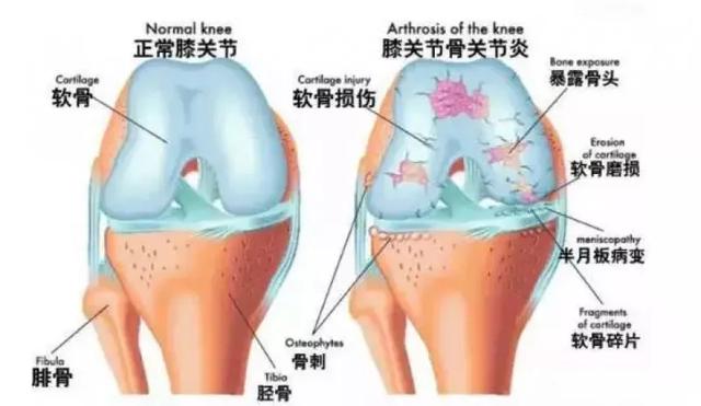 关节|60岁后，八成人软骨磨得只剩一半！简单一招，养关节，护骨骼