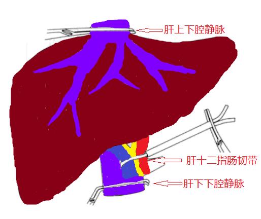 中山七院成功开展一例全肝血流阻断下巨大肝癌切除联合下腔静脉癌栓取出术