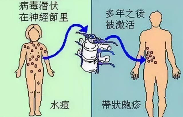 一文带你认识治疗带状疱疹的药物