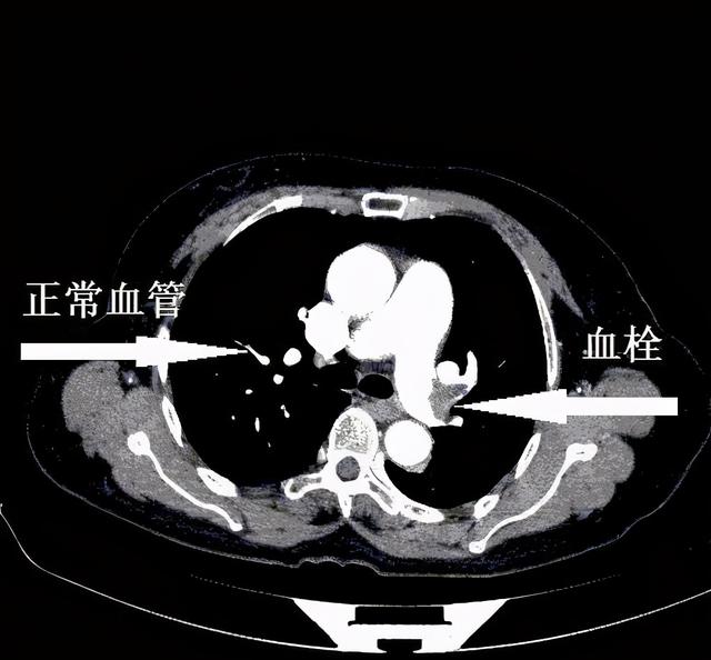 主持人突发急症死亡，致死速度不亚于心肌梗死，也是血管堵塞所致