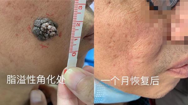 袁先生|男子频繁生抠硬拽，脸部芝麻小痣半年长至1.5cm大