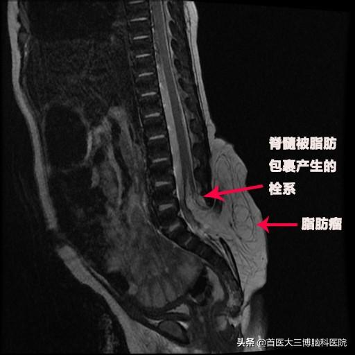 #你的育儿经#刚出生的宝宝屁股后有鹅蛋大的鼓包 三博医生妙手修补脊柱裂