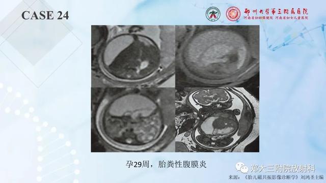 儿童腹部囊性病变诊断思路分析