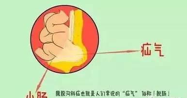 『你的育儿经』疝气老人小孩都易得，先天和后天应如何分辨，专家告诉你答案