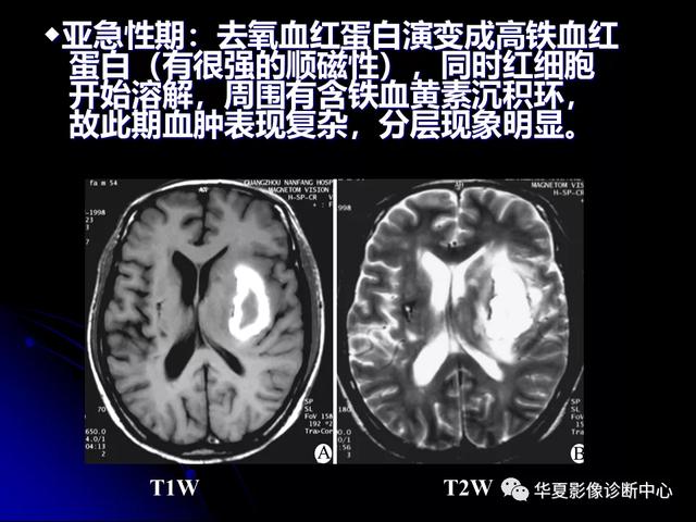 「影像复习」脑干区常见病变影像表现