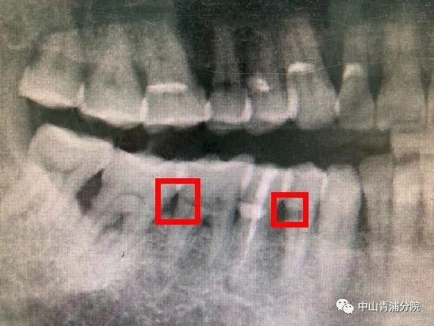 牙齿|牙齿楔状缺损，你刷牙方法对了吗？