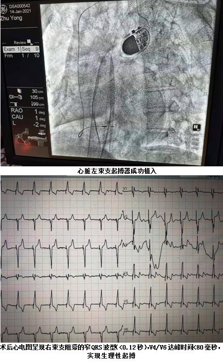 心突破！心跨越！怀化市二医院成功开展心脏左束支起搏器植入术