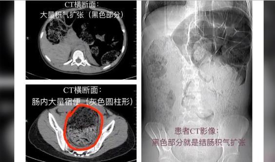 高二女生腹痛难忍寻医，一次排出8斤……马桶都堵了