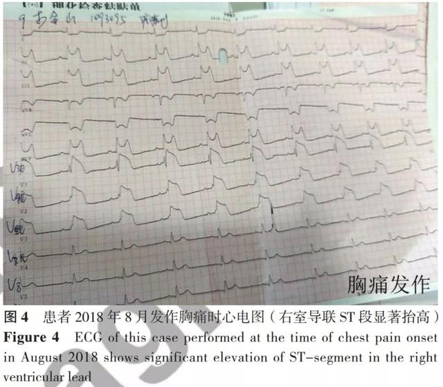 全科诊疗思路——冠状动脉无阻塞病变的变异型心绞痛患者的诊治过程