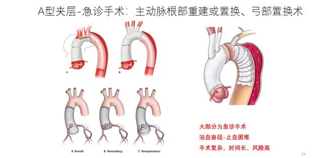 主动脉|生死时速，崇明大叔闯过“鬼门关”！心胸外科最凶险急症，随时致命