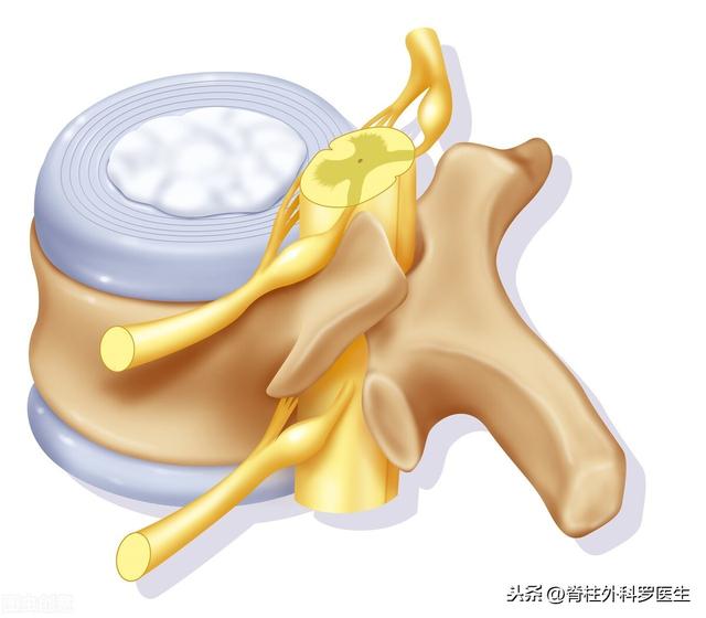 医生，我的腰是好好的，仅仅腿痛腿麻，怎么可能是腰椎间盘突出呢