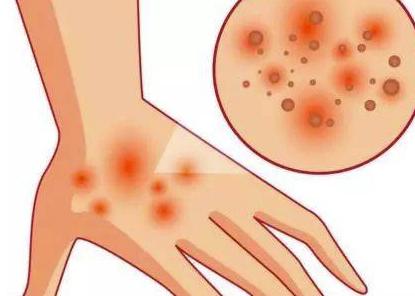 薏米|夏天容易得湿疹？来喝这碗汤