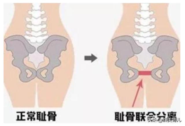 超级宝妈■痛到裂开！耻骨痛有多痛？许多孕妈们的噩梦，不妨试试这些小贴士