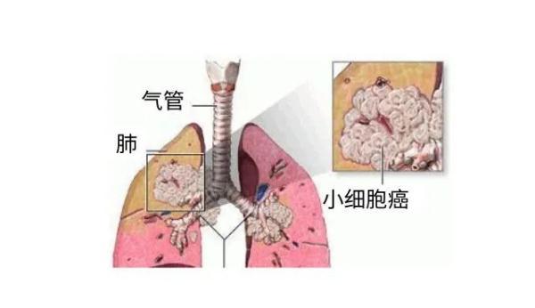 患者|每小时3人得癌！最新深圳肿瘤榜，头号杀手仍是它……这些习惯要赶紧戒