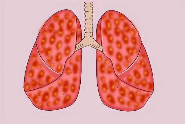 医生坦言：最不希望患者碰到3种癌，发作前毫无征兆，要早作预防