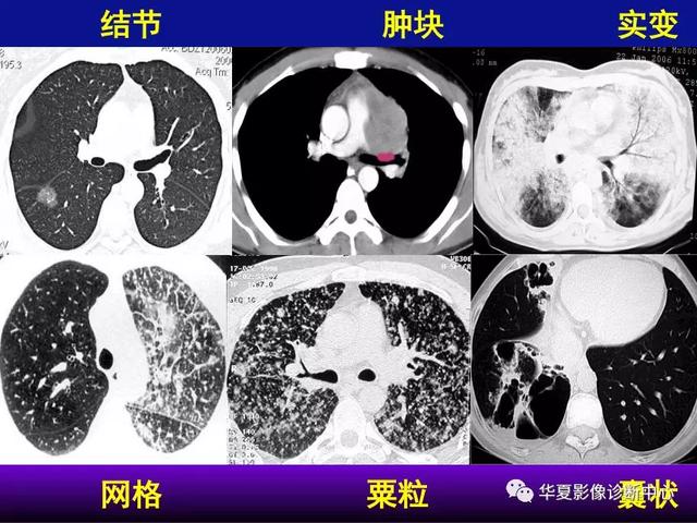 肺间质性疾病的解剖、病理、影像分析