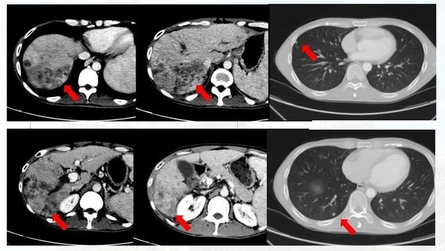 名医说肿瘤｜31岁男子患晚期肝癌肺转移，4个月后奇迹发生…
