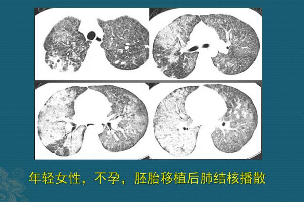 肺结核病人与肥皂的缘分，医生教你用CT片诊断肺结核