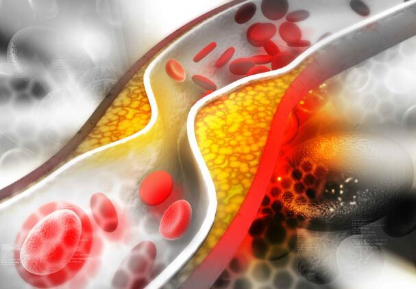 血管怕堵，常吃这5种食物，可软化血管、清除血管垃圾