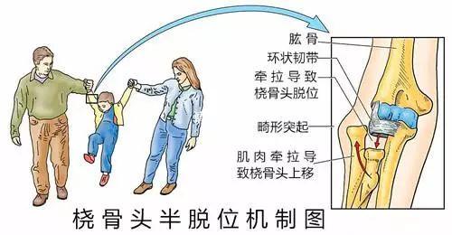 超级宝妈|小孩手肘痛不敢动，原来是脱位了
