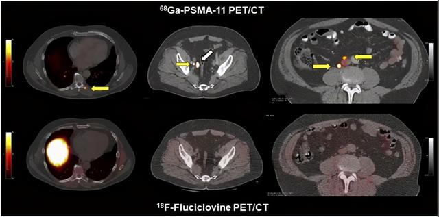 首个前列腺癌PET成像药物获批，提前发现前列腺癌病变