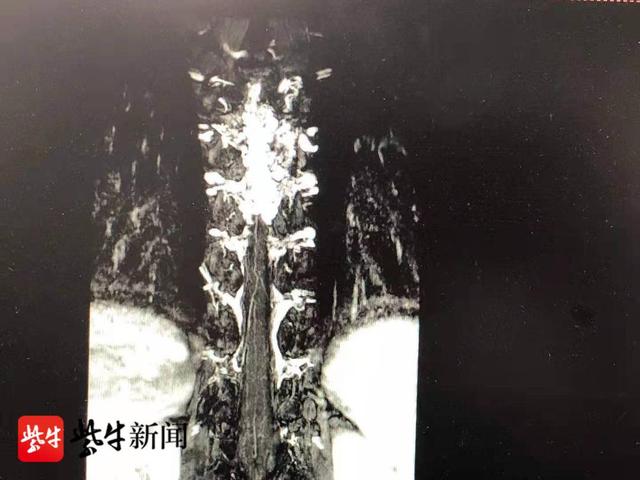 手术|吓人！这种瘫痪可能就在一瞬间，年初三11个小时紧急手术挽救了17岁的她