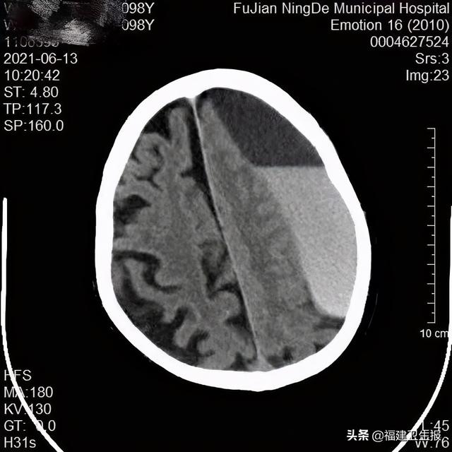 王大爷|宁德102岁老人摔跤后引发硬膜下出血！医生：年纪越大越容易出现